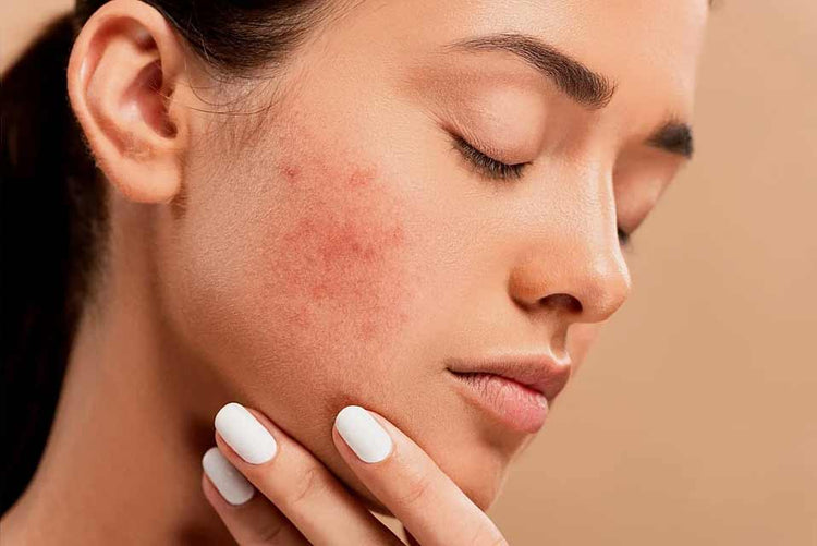 Acne Solutions